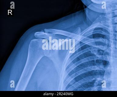 Immagine radiografica di dolore alla spalla, tendinite del legamento della spalla, sforzo muscolare della spalla Foto Stock