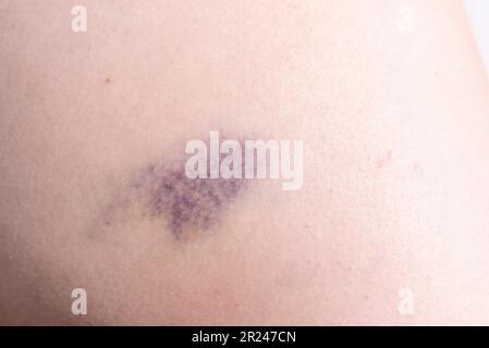 Closeup Blu ematoma viola, lividi su coso, anca dopo Trauma, caduta. Piano orizzontale. Sangue coagulato, lesione sul concetto di corpo umano. Foto Stock