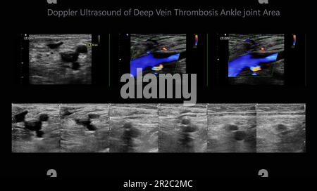 Determinazione ecografica Color Doppler in pazienti affetti da trombosi venosa profonda per l'individuazione di trombosi venosa profonda delle estremità inferiori. Foto Stock