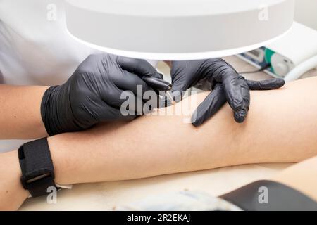 Irsutismo, Closeup processo di rimozione dei capelli con elettrolisi a mano di giovane donna bianca, epilazione elettrica nel salone di bellezza. Piano orizzontale Foto Stock