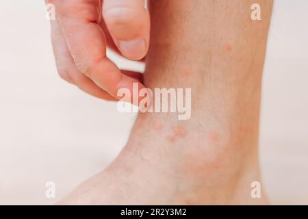 Primo piano l'uomo che graffia con eruzione cutanea allergica alla mano sulla gamba. Gamba con eruzione cutanea rossa causata da punture di insetti. Dermatite, follicolite, infezione fungina. Interessato Foto Stock