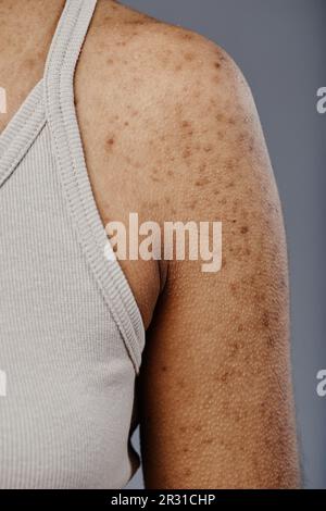 Immagine di dettaglio di primo piano di una giovane donna nera con vera struttura della pelle e cicatrici acne su spalle e braccia Foto Stock