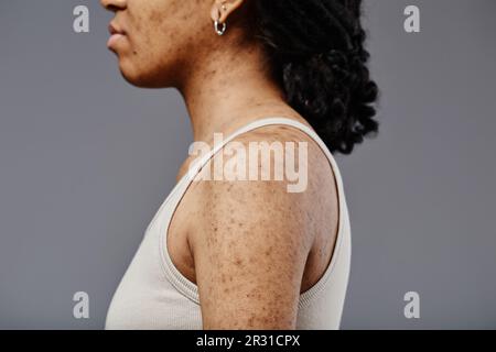 Primo piano vista laterale di una giovane donna nera con vera struttura della pelle e cicatrici acne su spalle e braccia Foto Stock