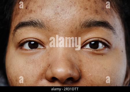 Primo piano di giovane donna nera con cicatrici acne sul viso guardando la macchina fotografica Foto Stock