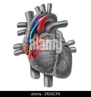Innesto del bypass dell'arteria coronaria o CABG come ostruzione della placca nell'arteria coronaria o nelle arterie come vena da una gamba che è innestata a un cuore Foto Stock