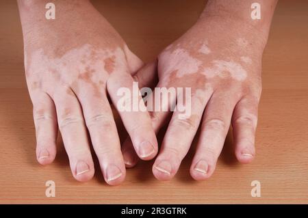 La vitiligine è una condizione medica causando la depigmentazione di patch di pelle Foto Stock