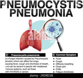 Poster informativo di Pneumocystis polmonite illustrazione Illustrazione Vettoriale