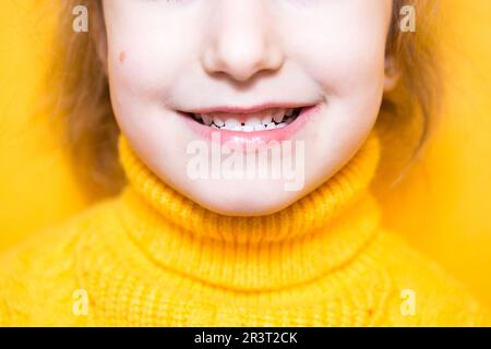 La ragazza mostra i suoi denti-morso patologico, malocclusione, overbite. Odontoiatria pediatrica e periodontica, correzione del morso. Salute An Foto Stock