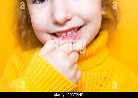 La ragazza mostra i suoi denti-morso patologico, malocclusione, overbite. Odontoiatria pediatrica e periodontica, correzione del morso. Salute An Foto Stock