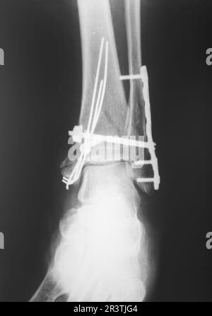 Raggi X della gamba rotta Foto Stock
