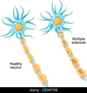 Sclerosi multipla. malattia autoimmune. confronto di un neurone sano e di un neurone con una guaina di mielina danneggiata. Nervo MS danneggiato dal sistema immunitario Illustrazione Vettoriale