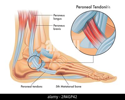Illustrazioni mediche dei sintomi della tendonite peroneale, con l'allargamento della zona colpita, con annotazioni. Foto Stock