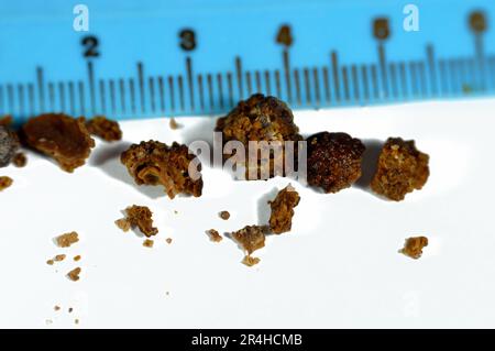 Nefrolitiasi, calcoli renali marroni irregolari (calcoli renali o nefroliti), le dimensioni dei calcoli sono diverse dopo ureteroscopia operativa e laser Foto Stock