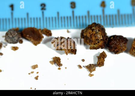 Nefrolitiasi, calcoli renali marroni irregolari (calcoli renali o nefroliti), le dimensioni dei calcoli sono diverse dopo ureteroscopia operativa e laser Foto Stock