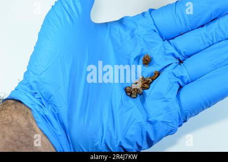 Nefrolitiasi, calcoli renali marroni irregolari (calcoli renali o nefroliti), le dimensioni dei calcoli sono diverse dopo ureteroscopia operativa e laser Foto Stock