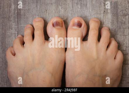 Piedi sul pavimento. Chiodi danneggiati. Lividi sotto l'unghia del pollice. Primo piano a piedi nudi. Malattia delle unghie. Trattamento sanitario. Concetto di cura dei piedi. Infezione del piede. Foto Stock