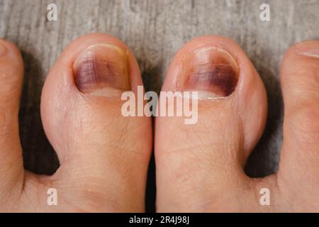 Piedi sul pavimento. Chiodi danneggiati. Lividi sotto l'unghia del pollice. Primo piano a piedi nudi. Malattia delle unghie. Trattamento sanitario. Concetto di cura dei piedi. Infezione del piede. Foto Stock