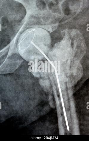 L'articolazione dell'anca a raggi X normali mostra la frattura trans cervicale sinistra della testa del femore con distanziatore temporaneo del caricatore antibiotico a poppa di cemento osseo caricato con antibiotici Foto Stock