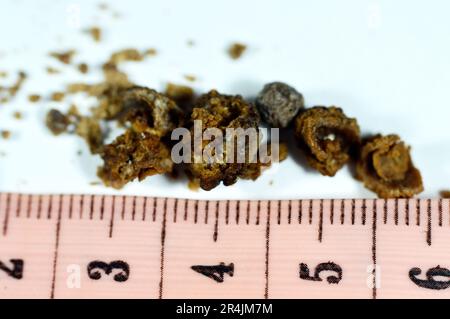 Nefrolitiasi, calcoli renali marroni irregolari (calcoli renali o nefroliti), le dimensioni dei calcoli sono diverse dopo ureteroscopia operativa e laser Foto Stock