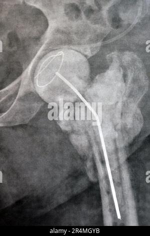 L'articolazione dell'anca a raggi X normali mostra la frattura trans cervicale sinistra della testa del femore con distanziatore temporaneo del caricatore antibiotico a poppa di cemento osseo caricato con antibiotici Foto Stock
