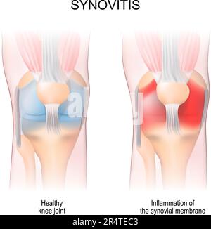 Sinovite. Anatomia dell'articolazione del ginocchio umana. Articolazione sana, e infiammazione della membrana sinoviale. vista frontale. aspetti anteriori. Illustrazione vettoriale Illustrazione Vettoriale
