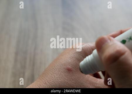 Zanzara morso a mano applicare la crema Foto Stock