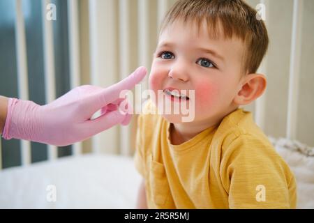 Il dermatologo pediatrico sta applicando la crema allergia alla guancia del bambino. Bambino di circa due anni (un anno undici mesi) Foto Stock