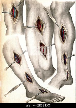 Medicina, anatomia, chirurgia dei vasi sanguigni degli arti inferiori: Quattro illustrazioni che mostrano tagli nella gamba e nel piede, con strumenti chirurgici che indicano vasi sanguigni, 1834, riproduzione storica, restaurata digitalmente da un originale del 19th ° secolo / Medizin, Anatomie, Chirurgie der Blutgefäße der unteren Gliedmaßen: vier Abbildungen mit Schnitten in Bein und Fuß, mit chirurgischen Instrumenten, die Blutgefäße anzeigen, 1834, Historisch, Ristorante digitale Reproduktion von einer Vorlage aus dem 19. Jahrhundert Foto Stock