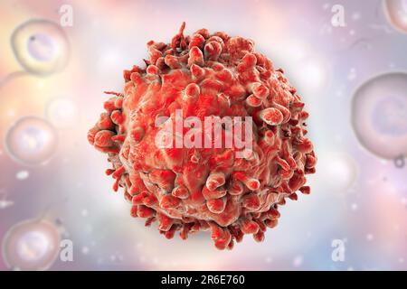 Computer illustrazione di un cancro delle cellule bianche del sangue nella leucemia. Foto Stock