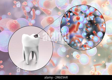 Carie dentali. Illustrazione di un dente con cavità e vista ravvicinata dei batteri che causano la formazione di carie. Foto Stock