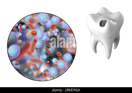 Carie dentali. Illustrazione di un dente con cavità e vista ravvicinata dei batteri che causano la formazione di carie. Foto Stock