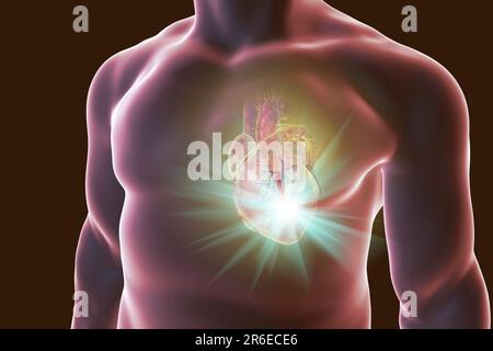 Attacco di cuore, concettuale illustrazione del computer. Foto Stock