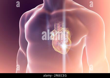 Attacco di cuore, concettuale illustrazione del computer. Foto Stock