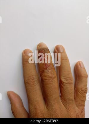 eruzione cutanea eczema dermatite sulla mano. infiammazione della pelle Foto Stock
