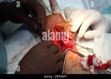 Intervento chirurgico per cucire il polso. Il team di neurochirurghi e traumatologi ridanno la mano. Chirurgia per cucire nervi e tendini al polso. Foto Stock