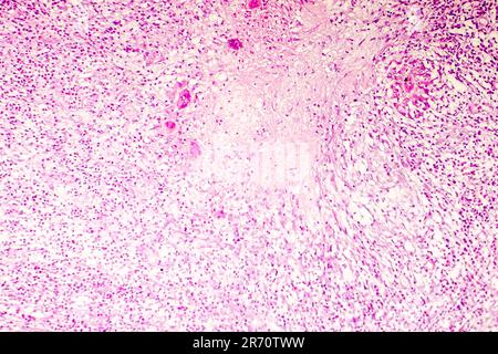 Necrosi liquefattiva del cervello umano, fotomicrografia leggera che mostra la perdita di contorni cellulari, accumulo di detriti cellulari, infiltratio macrofago Foto Stock