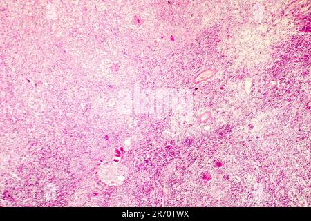 Necrosi liquefattiva del cervello umano, fotomicrografia leggera che mostra la perdita di contorni cellulari, accumulo di detriti cellulari, infiltratio macrofago Foto Stock