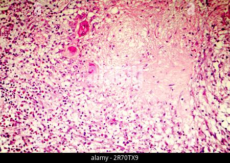 Necrosi liquefattiva del cervello umano, fotomicrografia leggera che mostra la perdita di contorni cellulari, accumulo di detriti cellulari, infiltratio macrofago Foto Stock