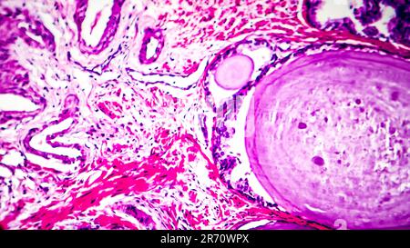 Istopatologia dell'iperplasia della ghiandola prostatica, micrografia leggera, foto al microscopio Foto Stock