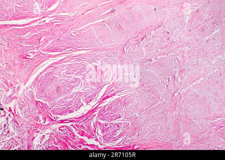 Micrografia leggera del tessuto cicatriziale. Foto al microscopio di una cicatrice formata durante la guarigione della ferita Foto Stock