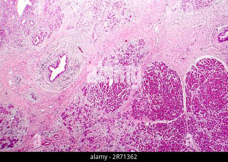 Emorragica acuta pancreatite, micrografia di luce, ematossilina ed eosina Foto Stock