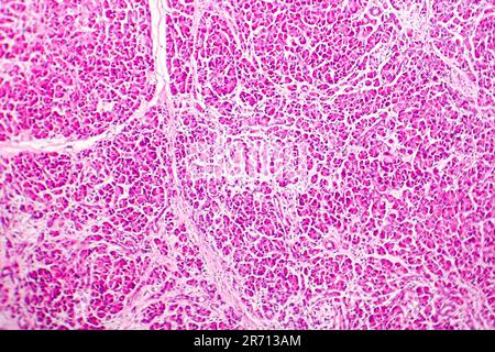 Emorragica acuta pancreatite, micrografia di luce, ematossilina ed eosina Foto Stock