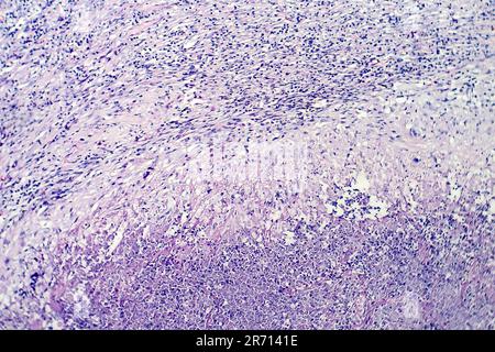 Istopatologia della tubercolosi, micrografia leggera della lesione della tubercolosi, foto al microscopio a basso ingrandimento Foto Stock