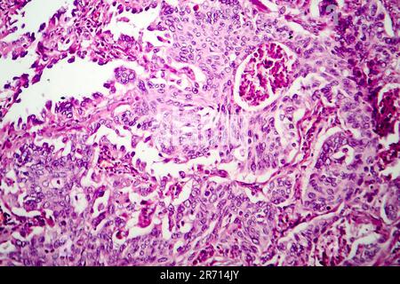 Adenocarcinoma polmonare, micrografia leggera, foto al microscopio Foto Stock