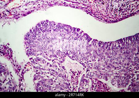 Adenocarcinoma polmonare, micrografia leggera, foto al microscopio Foto Stock