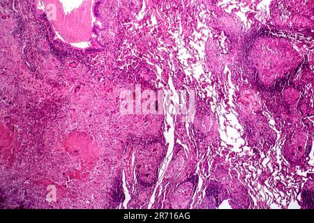 Caseous polmonite, micrografia di luce, foto al microscopio. La tubercolosi la polmonite Foto Stock