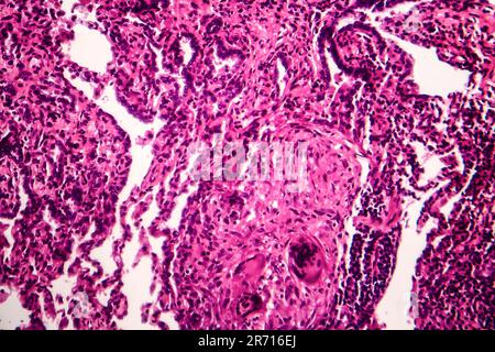 Caseous polmonite, micrografia di luce, foto al microscopio. La tubercolosi la polmonite Foto Stock