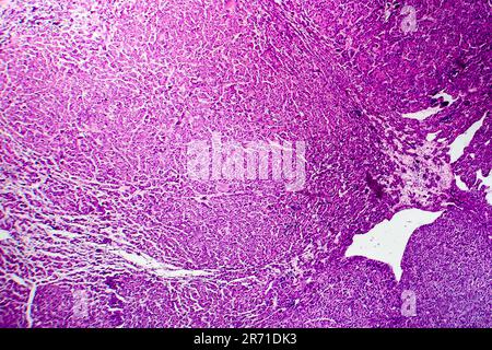 Carcinoma epatocellulare, cancro del fegato, micrografia leggera, foto al microscopio Foto Stock