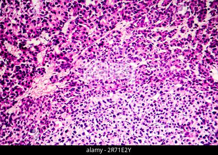 Carcinoma epatocellulare, cancro del fegato, micrografia leggera, foto al microscopio Foto Stock