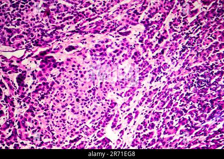 Carcinoma epatocellulare, cancro del fegato, micrografia leggera, foto al microscopio Foto Stock